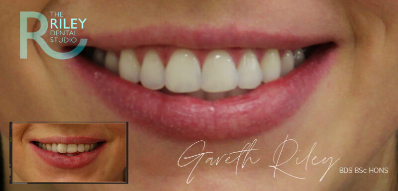 Raynard Riley Dentist Smile Gallery | Transformations at The Riley Dental Studio