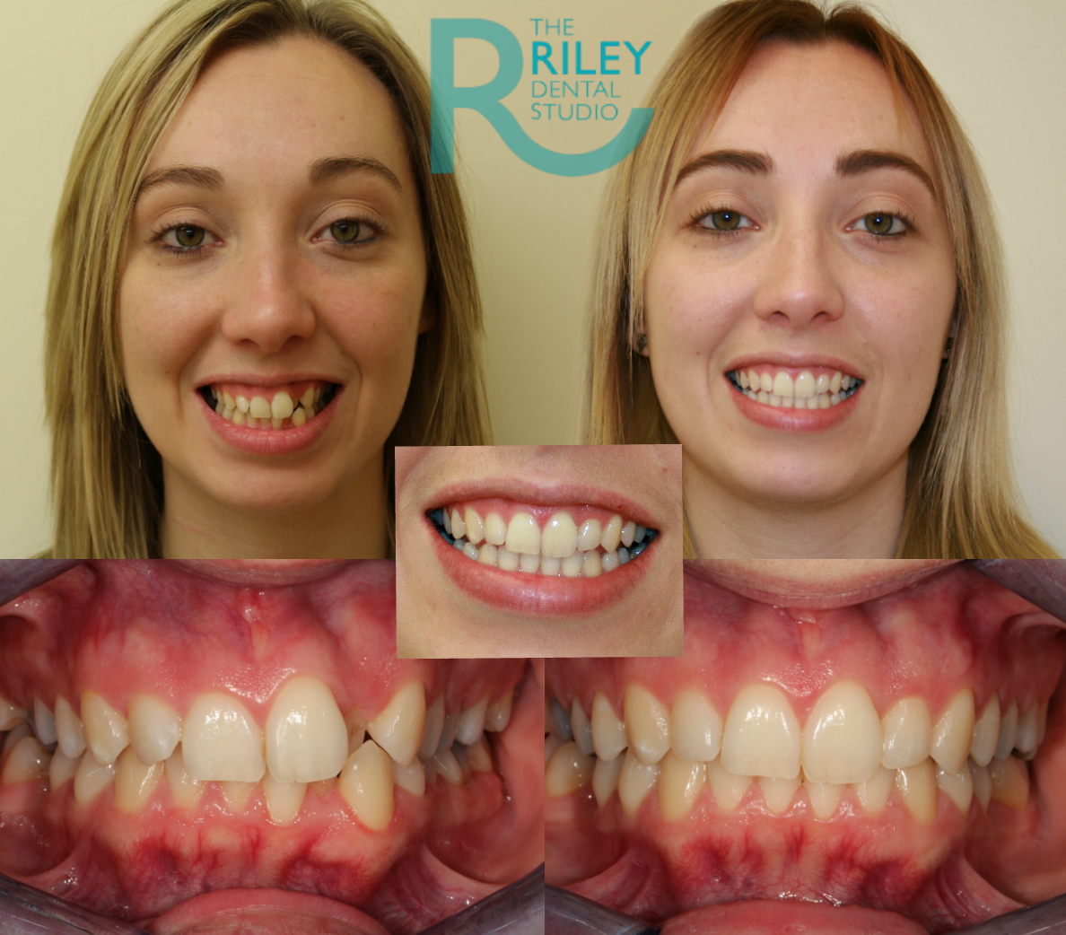 Invisalign Before and After - The Dental Room